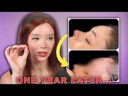 1 Year Facial Feminization Surgery Update! (Sensation, Scarring, Hair Regrowth, +more)