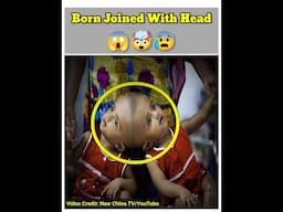 Baby Born Joined With Head