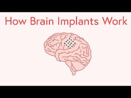 How Brain Implants Work