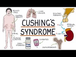 Understanding Cushing's Syndrome