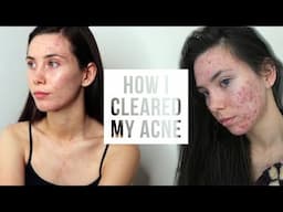 HOW I CLEARED MY CYSTIC ACNE NATURALLY #normalisingacne | Cerys Davies