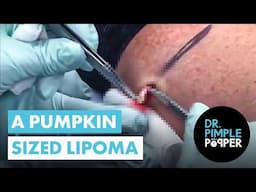 A Pumpkin Sized Lipoma