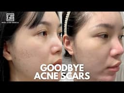 I Tried Acne Scar Removal using OXYGEN?! in Korea—See the AMAZING Results! | Seoul Guide Medical