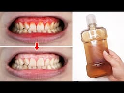 Heal Your Bleeding Gums with This Minty Natural Mouthwash Recipe! 100% effective