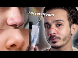 OMG! This Cream Erases Blackheads & Whiteheads Like Magic! 😱