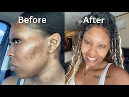 How I Cleared My Acne + Dark Spots + Hyperpigmentation in 1 Month (VIDEO PROOF) No Accutane