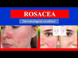 ROSACEA - Definition, types, causes, pathophysiology, signs & symptoms, medicine