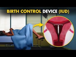 How intrauterine device (IUD) works: 3d animation