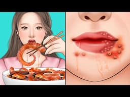 ASMR Mukbang acne extract around mouth corner | Pimple popping animation