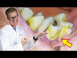 Patient's Tooth FALLS OUT During Deep Cleaning! TONS OF PLAQUE, TARTAR, & GROSS Bacteria Removed