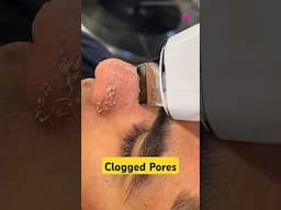 Best Way to Get Rid of Clogged Pores FAST! #pores #skincare #shorts #dadumedicalcentre