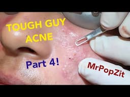 Tough Guy Acne part 4!Acne extractions.Make an appointment with me, details in description! Lets go!