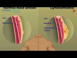 Gynecomastia- Insights and Issues - Dr. Biswajit Mishra | Manipal Hospital Bhubaneswar