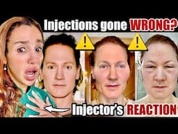 Bryan Johnson's Scary Reaction to Face Injections- Sculptra & Renuva gone WRONG!