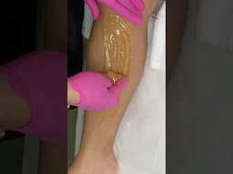 SUGARING | SUGAR WAX #waxing #hairremoval #sugarwaxing #sugarwax