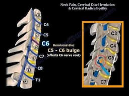 "Neck Pain, Cervical Disc Herniation, and Radiculopathy: Causes, Symptoms, and Treatment"