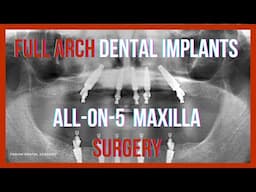 Full Arch Dental Implants: All-on-5 Recorded Surgery Edentulous Patient Online Course + Free e-Book!