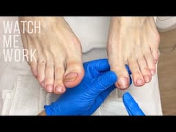 Pedicuring toenails with micro trauma [follow up]