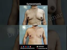 Gynecomastia surgery  results day 3