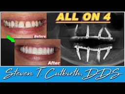 Fabulous All on 4 Dental Cases - Dental Minute with Steven T. Cutbirth, DDS