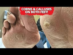 Extreme Corn & Callus Removal: Oddly Satisfying Results!