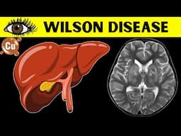 Wilson Disease - The Inherited Disorder Of Copper Metabolism - Everything You Need To Know