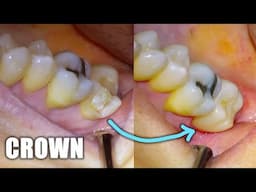 Full Dental Crown Procedure on Molar! Tooth Preparation Walkthrough, Placement, & Before and After!