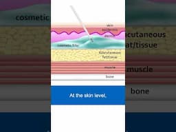 Facial Fillers: Comparing Skin-Level vs. Bone-Level Placement #dermalfillers