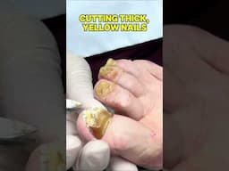 Cutting Thick Yellow Toenails! #foot #drkim #nails