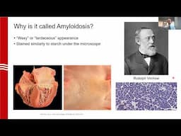 De-mystifying Amyloidosis  An Internist's Guide to Early Recognition