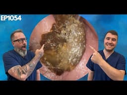 Removing Massive Ear Wax Blockages - EP1054