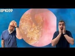 REMOVING THE MOST IMPACTED EAR WAX EVER! - EP1059