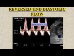 Gynae and Obs OSCE: Episode 1 'The doppler waveform' Normal vs Absent vs Reversed End-diastolic flow