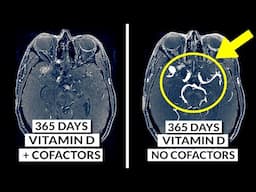 How To Safely Increase Vitamin D Levels (Supplements, Sunlight & Cofactors)