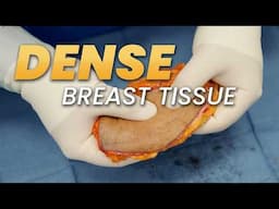 Dense Breast Tissue Got You Worried? Watch This Now