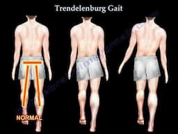 Trendelenburg Gait: Causes, Symptoms, and Role of the Gluteus Medius