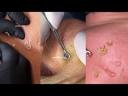 12 Minutes Of Top ASMR Pimple Popping Video