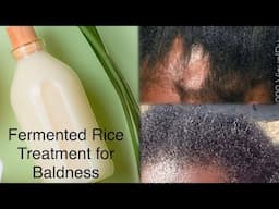 Fermented Rice Shampoo Treatment For Baldness, Regrowth Alopecia Hair Loss Fall And Baldness