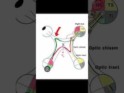 Junctional Scotoma  #insightophthalmology #visual field #ophthalmology