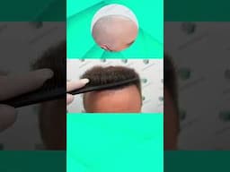 HAIR TRANSPLANT BY DR DE FREITAS