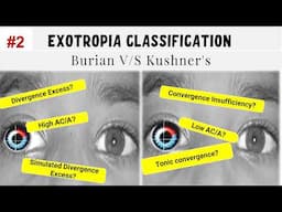 Classification of Exotropia | All you need to know