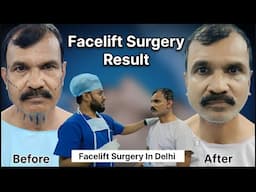 Facelift Surgery In Delhi | Facelift Surgery Cost in Delhi India | Zenith Clinic.