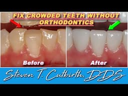 How to Fix Crowded Teeth Without Orthodontics - Dental Minute with Steven T. Cutbirth, DDS