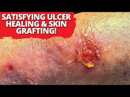 Venous Ulcer Grafting: The Satisfying Healing Transformation You Need to See!