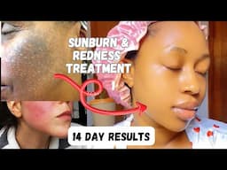 How to get rid of SUNBURN & REDNESS fast|Effective products & remedies that works