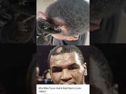 Sudden bald spots on men, filled in with Hair Unit #barber #hairlosstreatment #miketyson #haircare