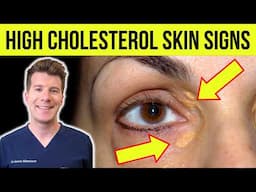 6 SKIN SIGNS associated with HIGH CHOLESTEROL