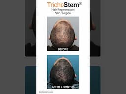 Why Thickening Thinning Covers More Scalp than a Hair Transplant #thinninghair