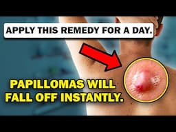 Papillomas Gone 1000%. The Simplest and Cheapest Way to Remove Skin Tags at Home.