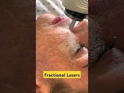 Laser Treatments for Face | Pimples and Acne Scar Laser Treatments #shorts #DMC